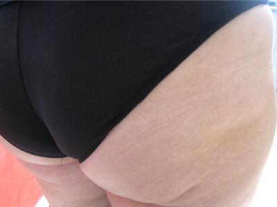 Image : Cellulite